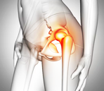 Hip Replacement